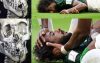 চোয়াল এবং মুখের বাঁ দিকের হাড় ভেঙে গেছে ইয়াসির আল শাহরানি
