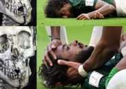 চোয়াল এবং মুখের বাঁ দিকের হাড় ভেঙে গেছে ইয়াসির আল শাহরানি